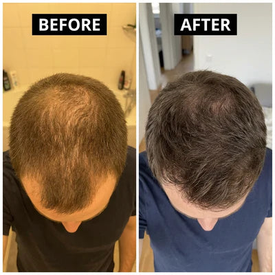 Before and after using CuCure GHK-Cu copper peptide hair care showing thicker, fuller hair and improved density