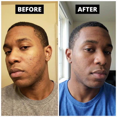 Before and after using CuCure GHK-Cu copper peptide skincare showing clearer skin and improved texture in 3 weeks