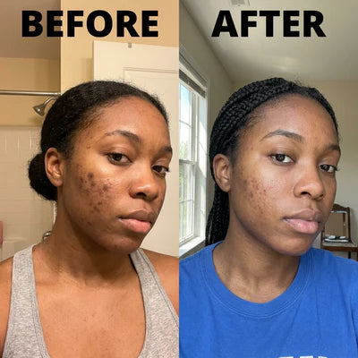 Before and after using CuCure GHK-Cu copper peptide skincare showing clearer skin and improved texture in a few weeks