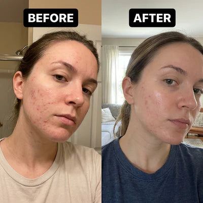 Before and after using CuCure GHK-Cu copper peptide skincare showing smoother skin texture and reduced redness after 5 weeks